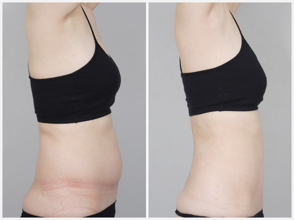 Before & After Image - body